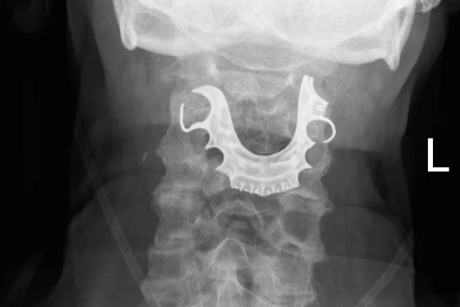 Pensioner Got False Teeth Stuck in Throat During Operation and No One ...