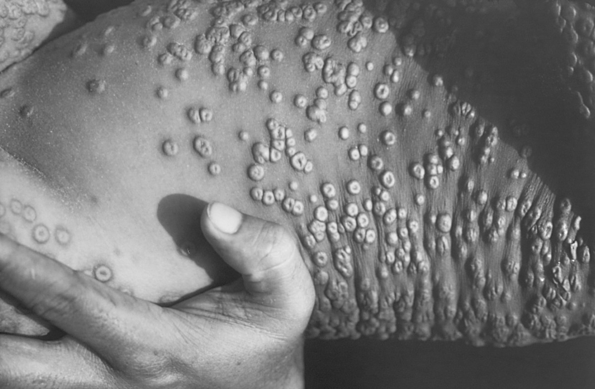 Smallpox Was Eradicated 40 Years Ago, So Why Are the U.S. and Russia ...