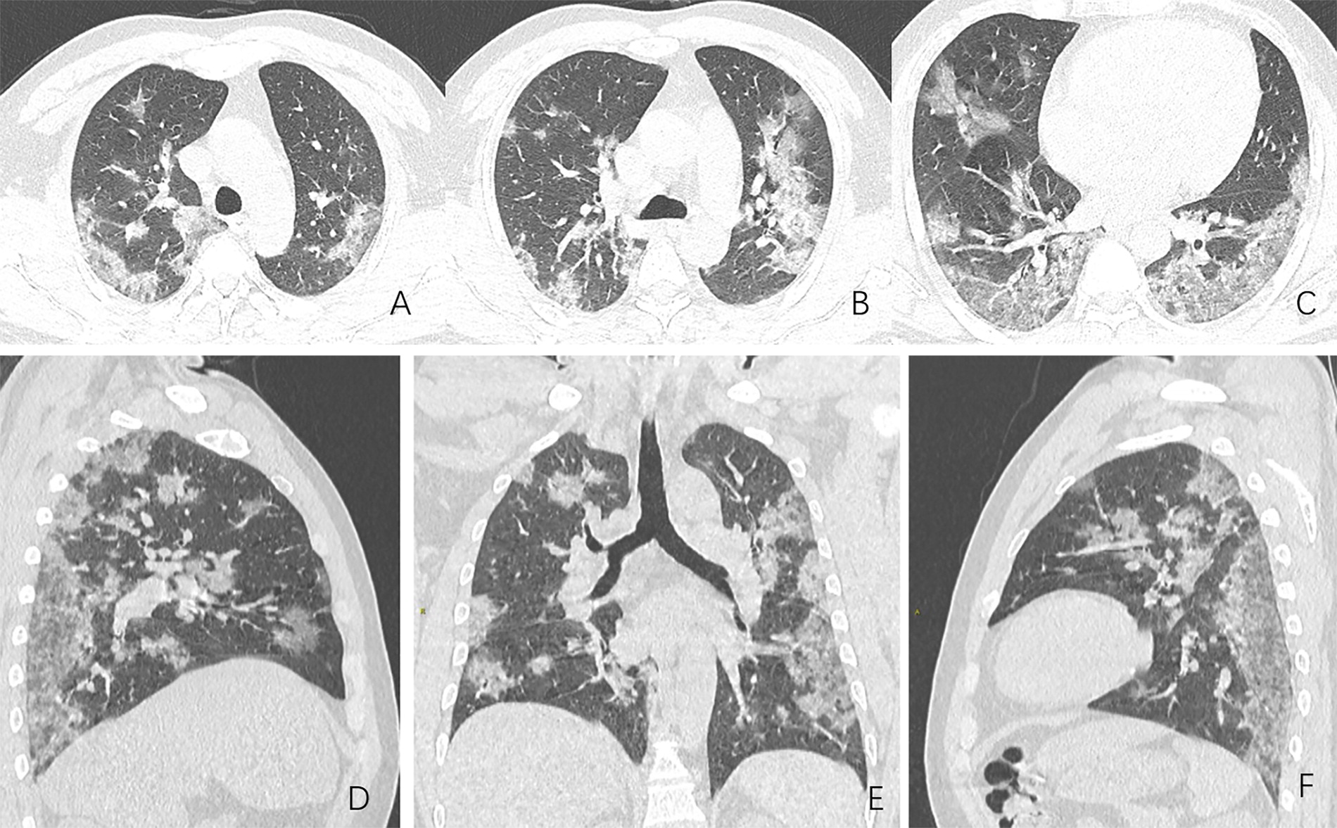CT Scans Show What Coronavirus Did to the Lungs of COVID-19