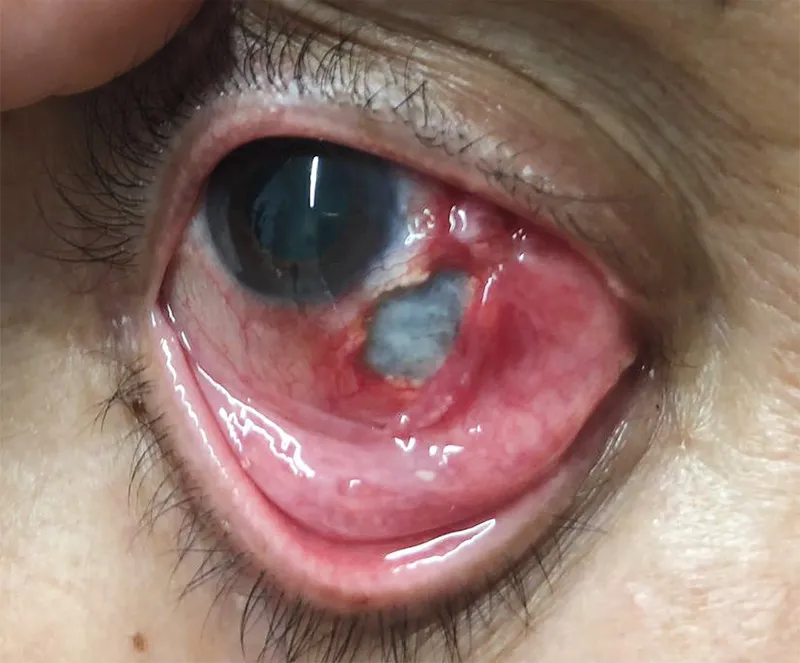 glp 1 eye rot Emerging Concerns: GLP-1 Modulators and Their Potential Risk to Vision GLP-1 receptor agonists in eye