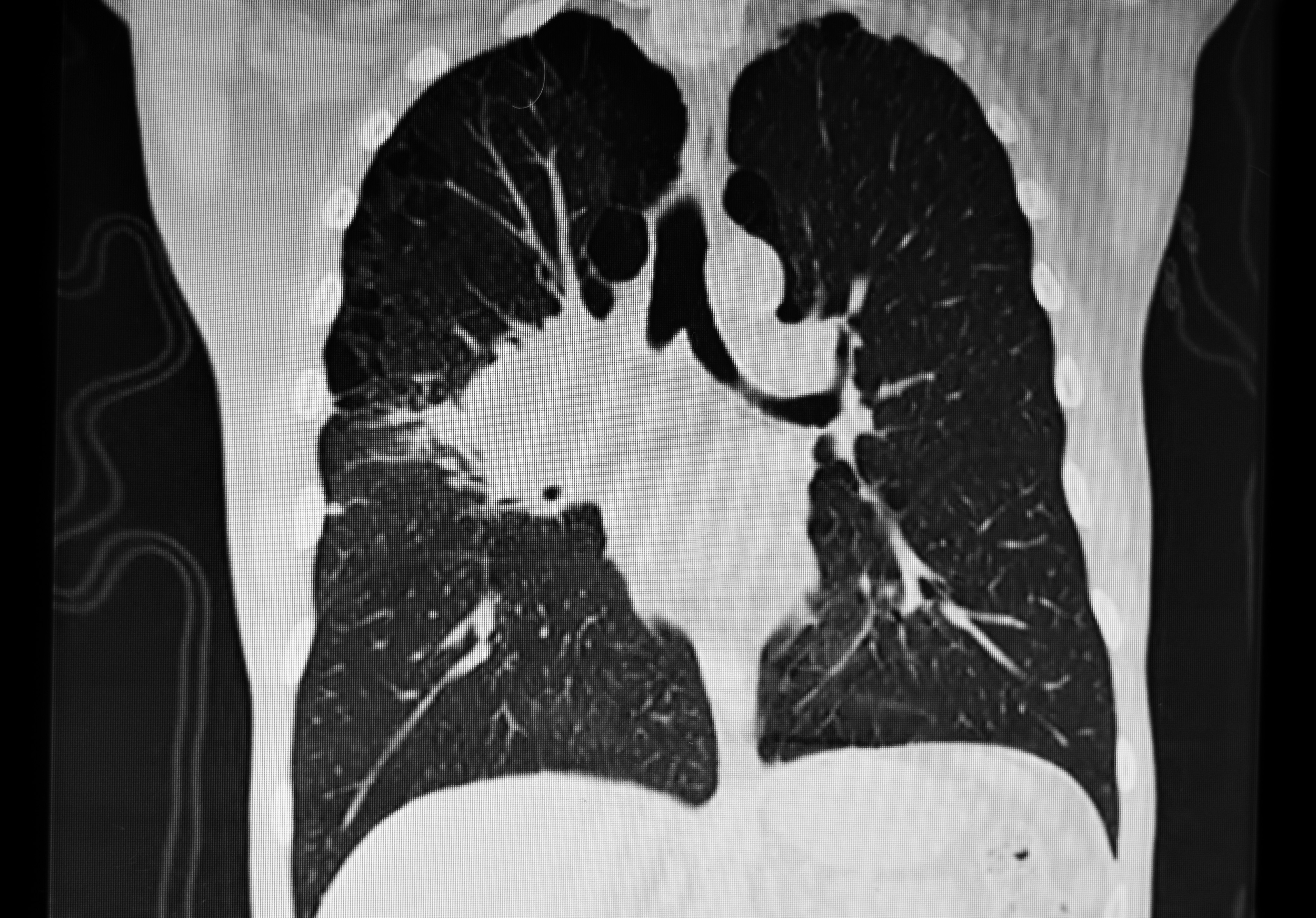 Graphic Video of Black Cigarette-Damaged Lungs Sees Smokers Quit on the  Spot