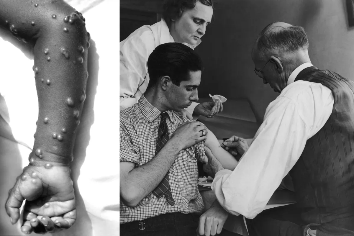 Smallpox Def The Severity of Smallpox Explained in ‘1883’ on Paramount+ - Newsweek