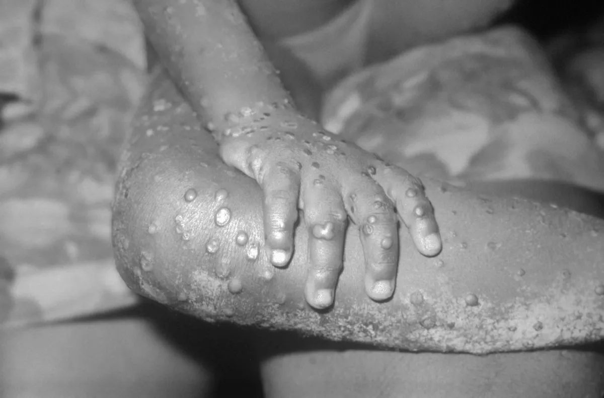 Monkeypox Pictures: What Do the Virus Lesions Look Like? - Newsweek