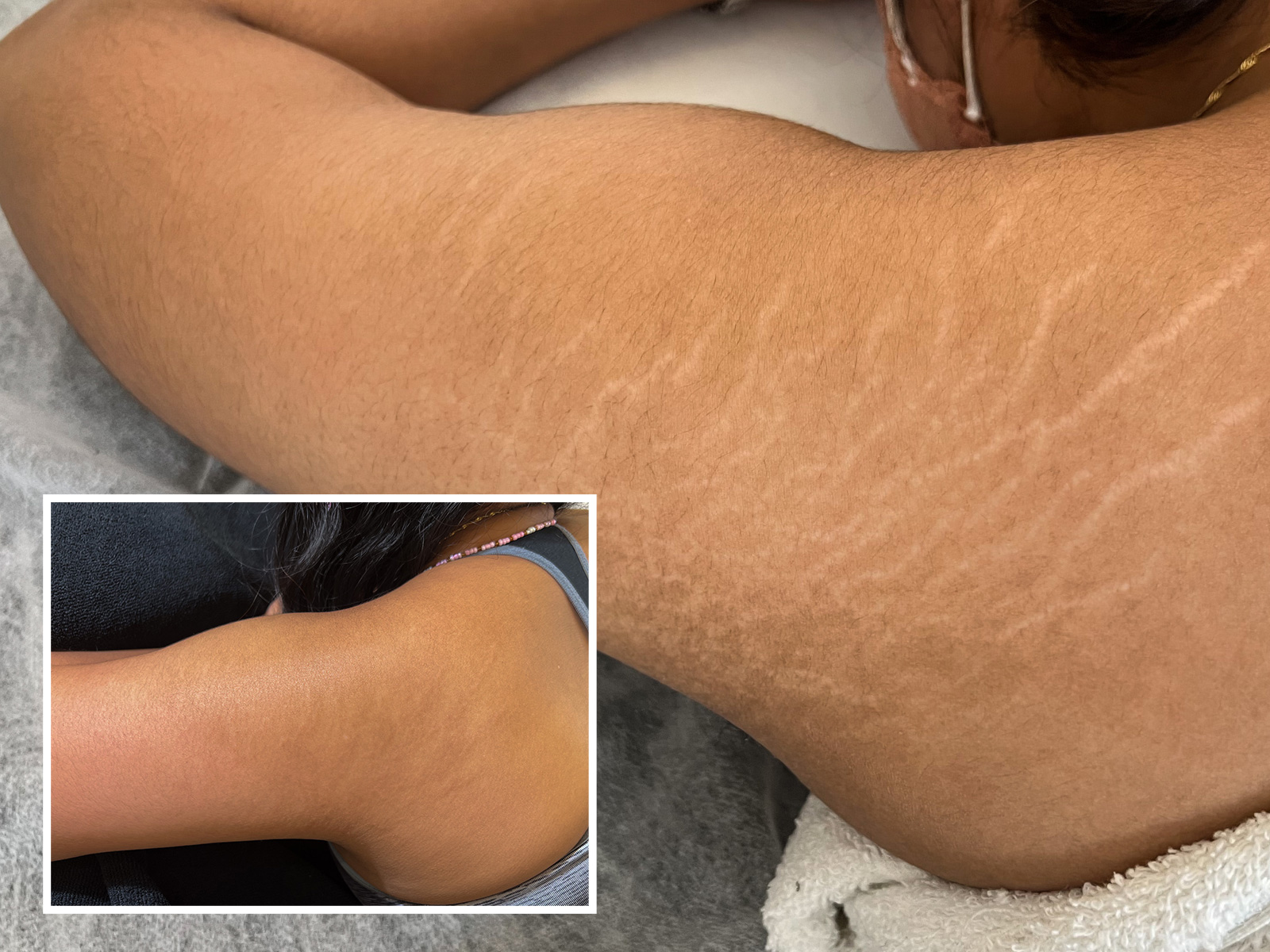 Stretch Mark Removal