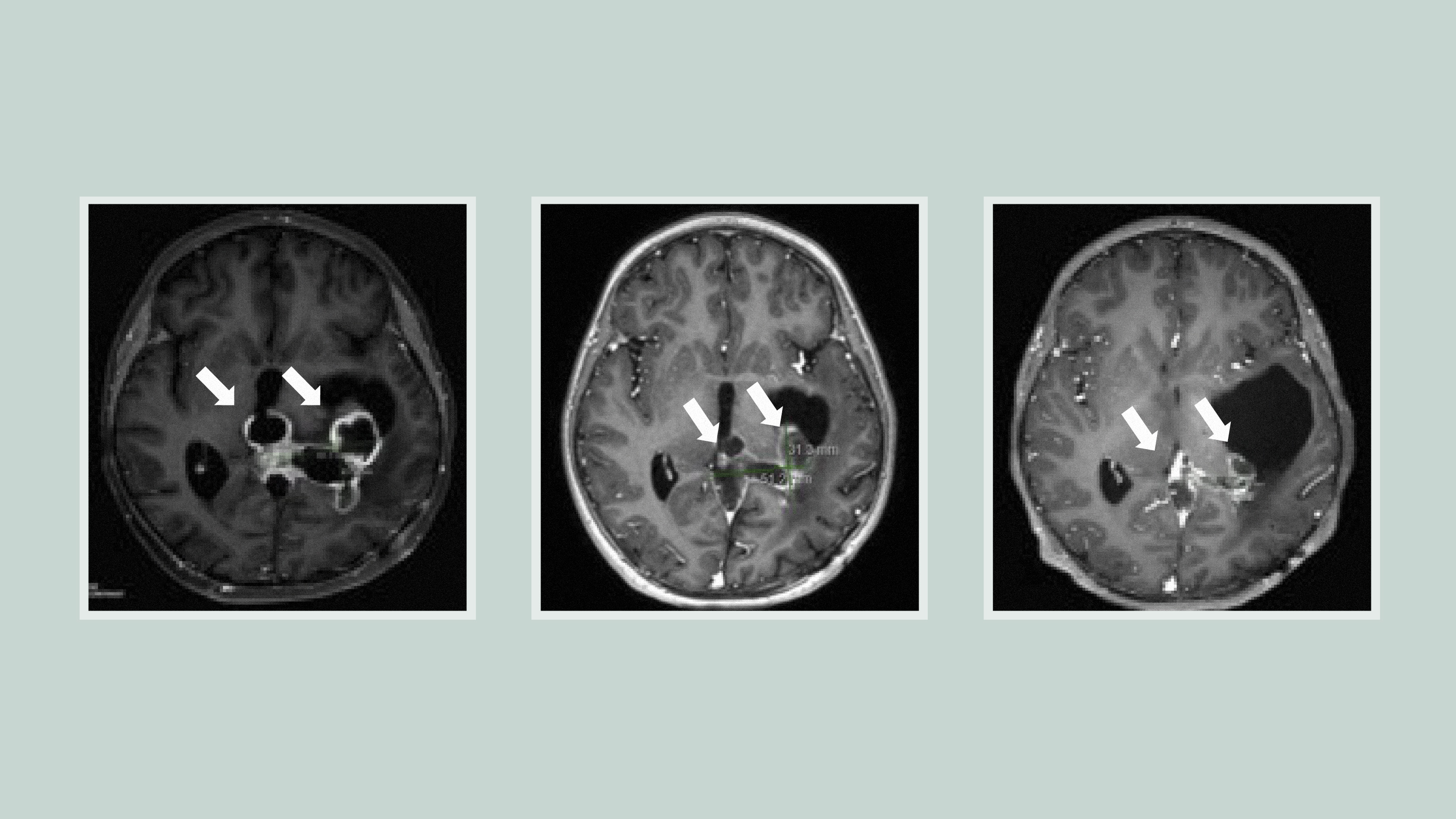 Scientists Find New Weapon Against Brain Tumor: 'Major Crack in