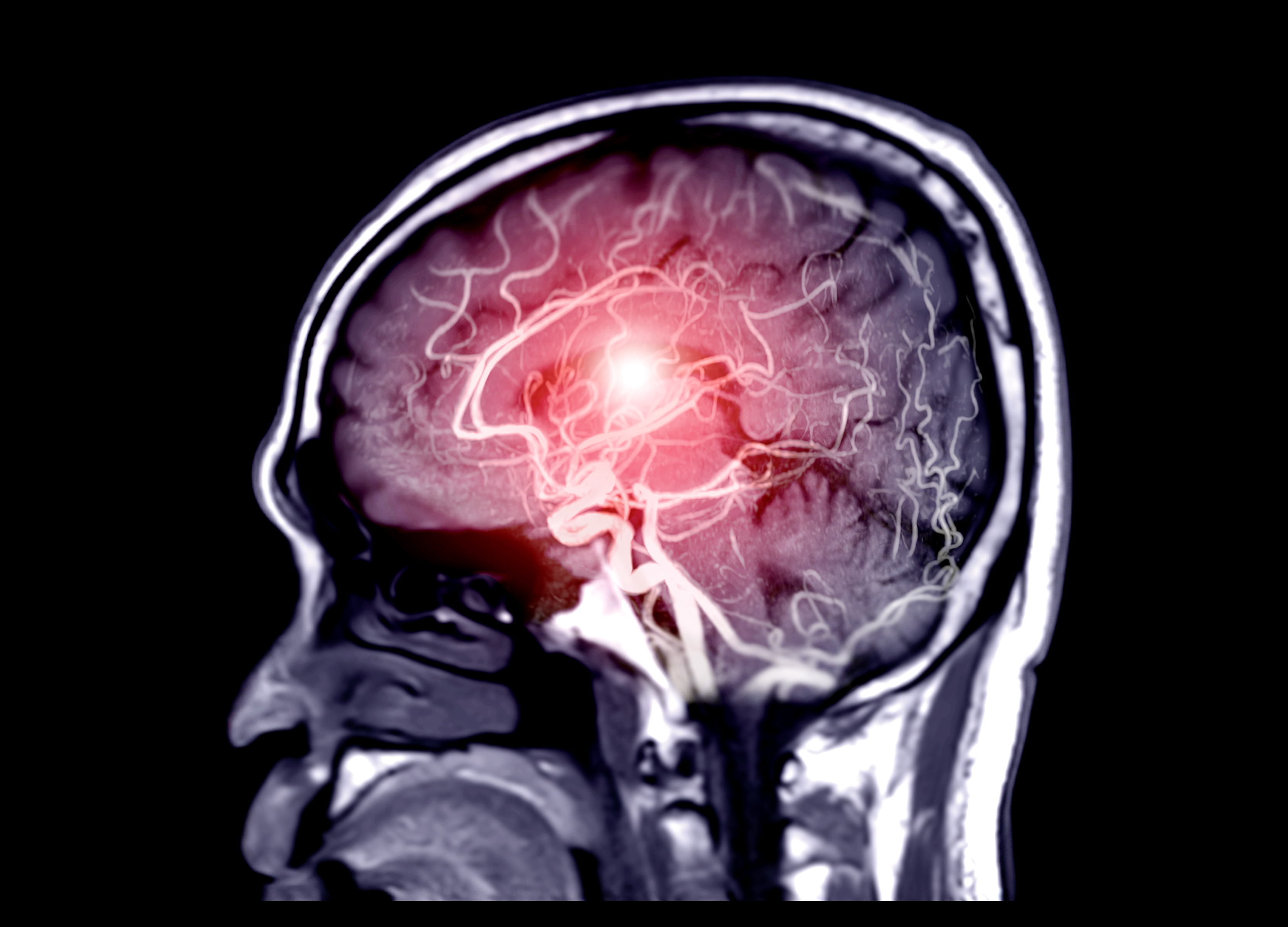 Just One Night Without Sleep Can 'Rewire' Our Brains for Days