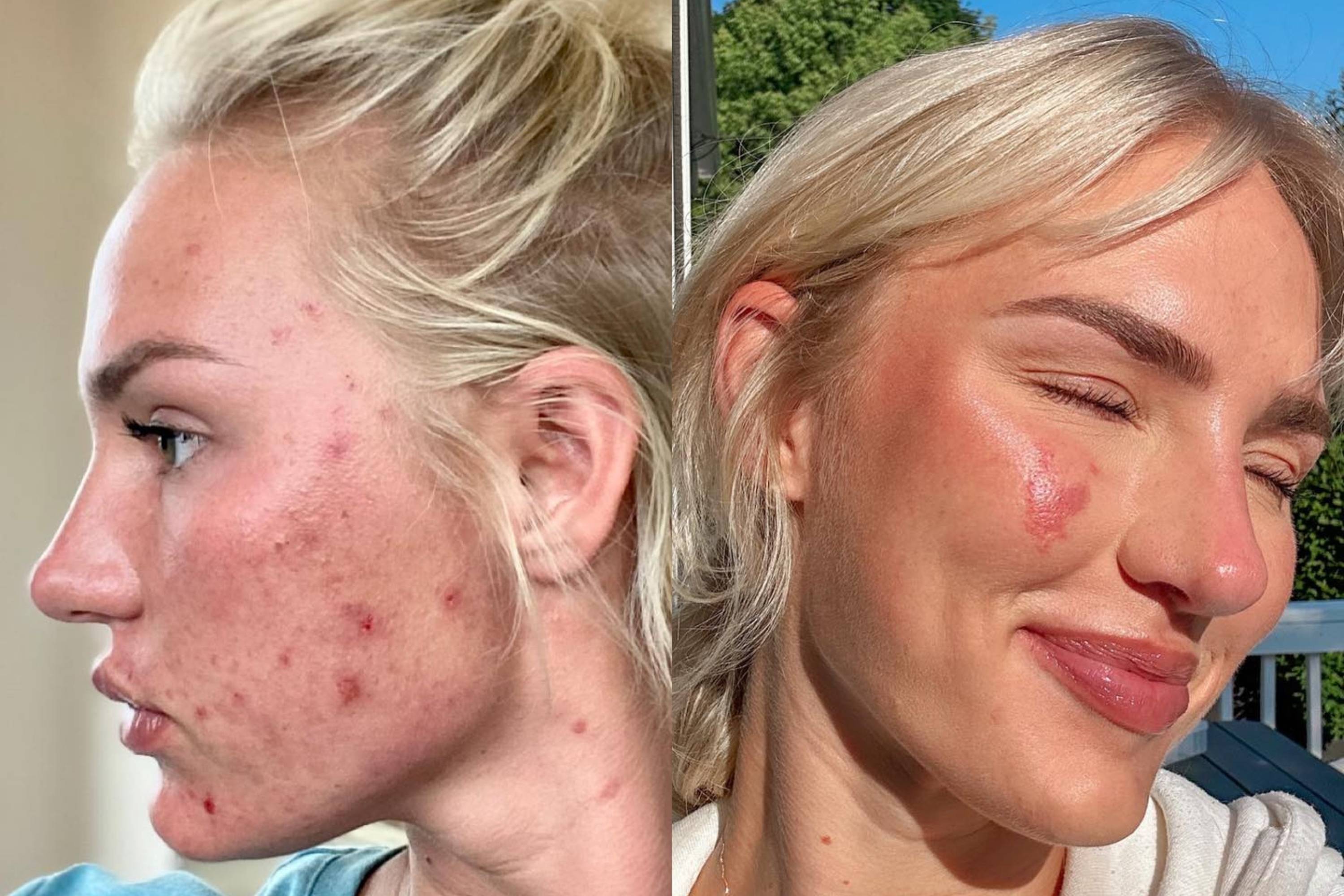 I Tried Everything to Heal My Acne. One Change Made a Huge Difference -  Newsweek, image size:3000x2000