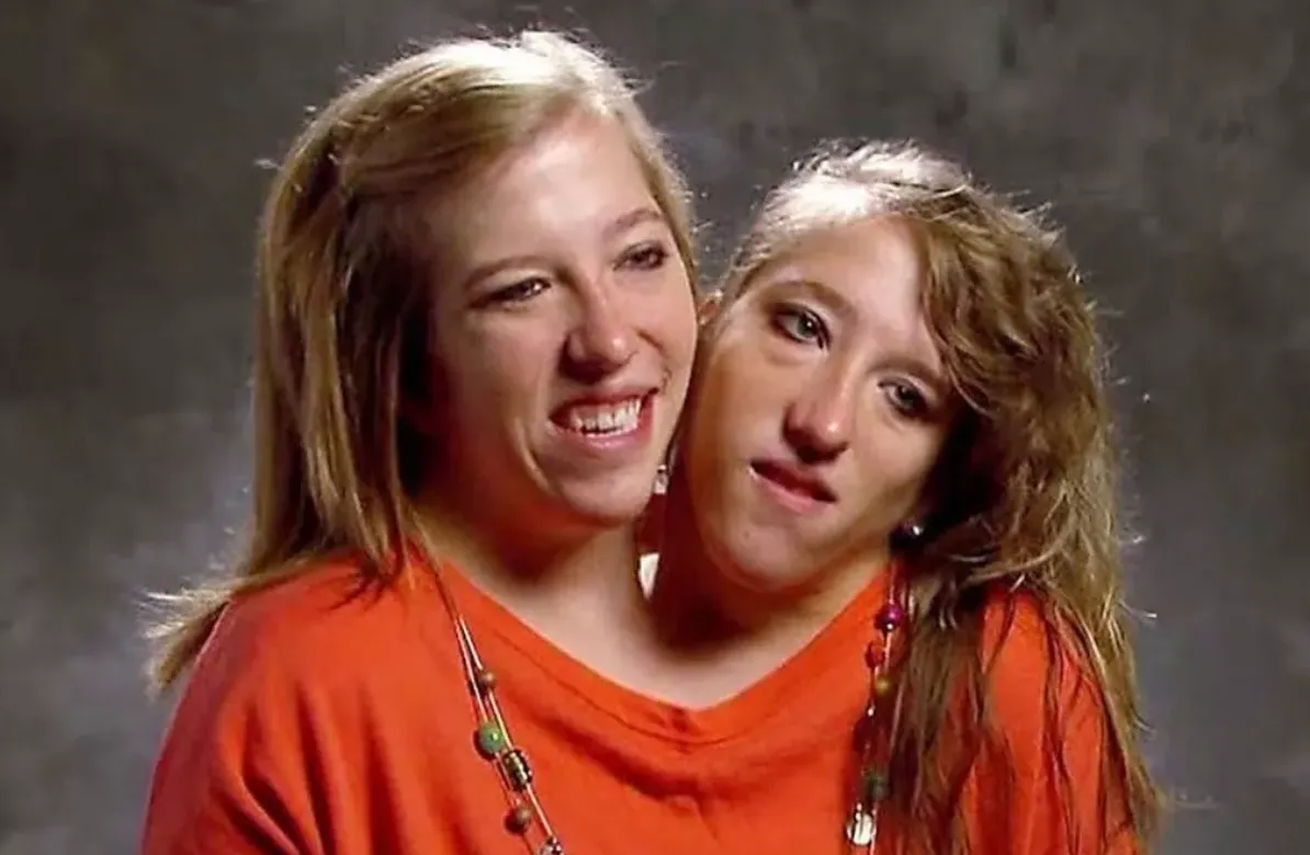 How Conjoined Twins Abby and Brittany Hensel Defying Odds - Newsweek