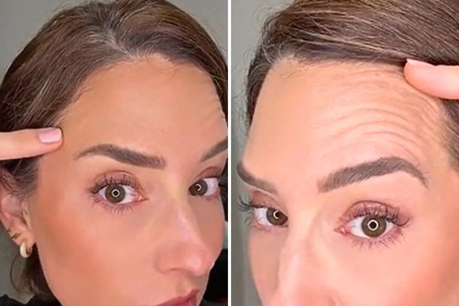 Nurse Uses Her Own Face to Show What Botox Really Does