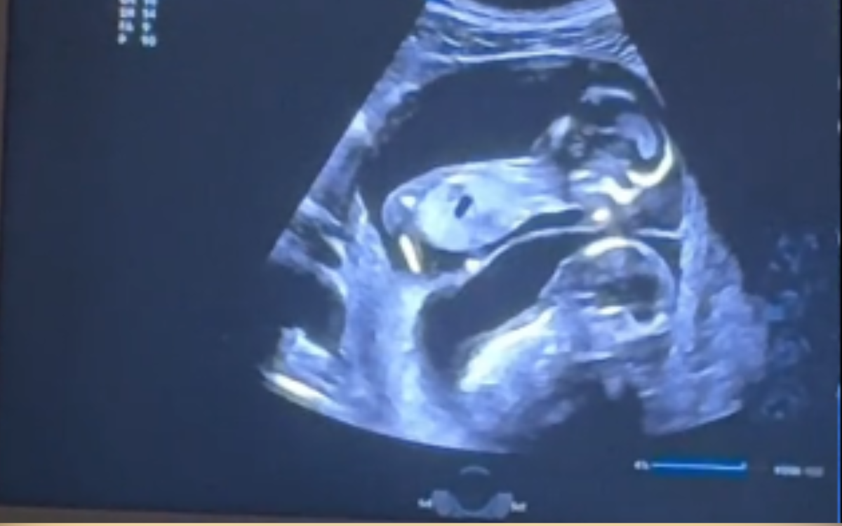 Pregnant Woman Carrying Twins Has Ultrasound—Shock at What It Reveals