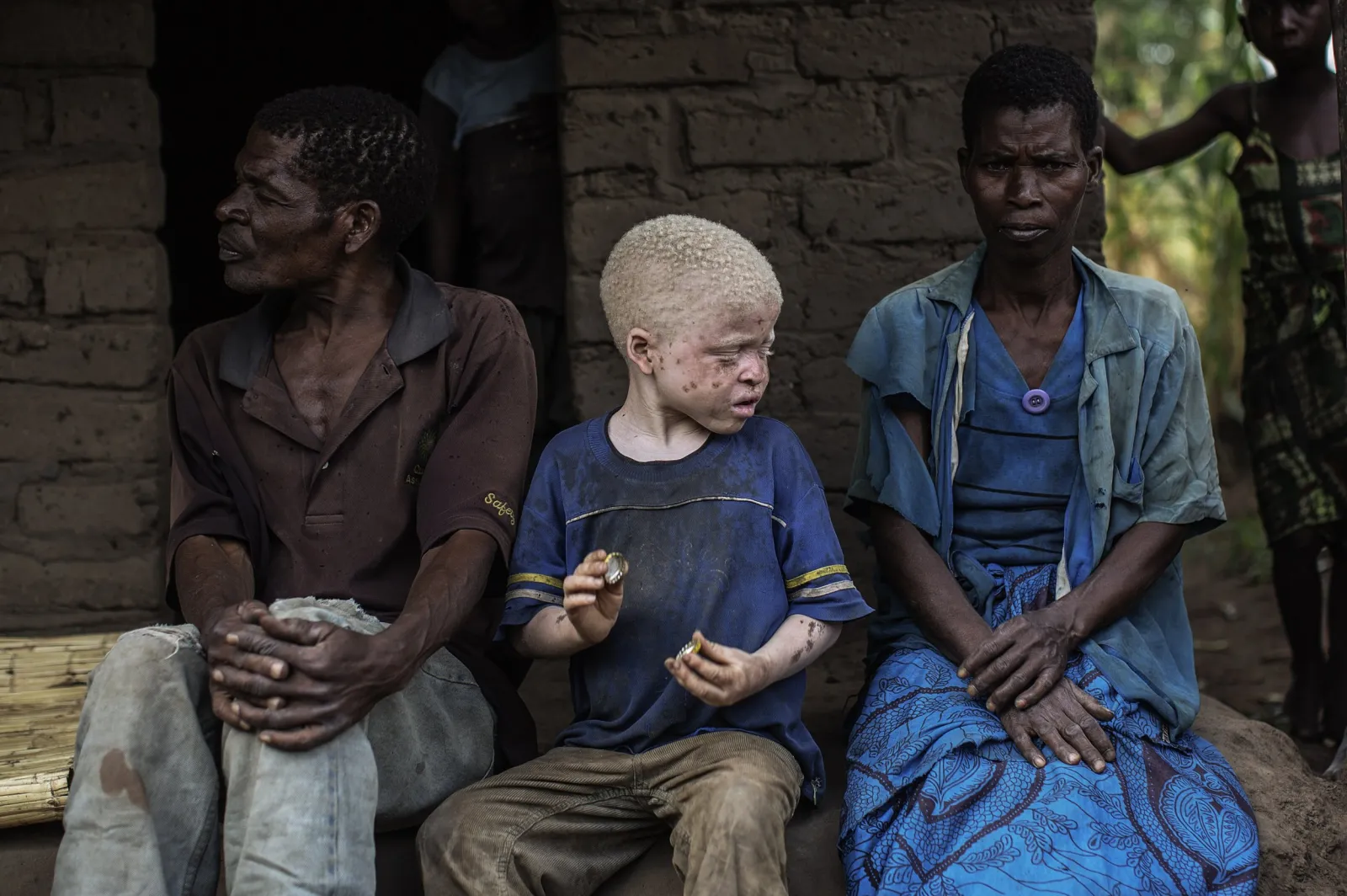 Malawi Bans Witchdoctors in Bid to Halt Albino Killings