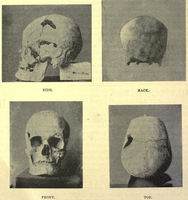 Ancient Egyptian Pharaoh Is World's Oldest Case of Gigantism
