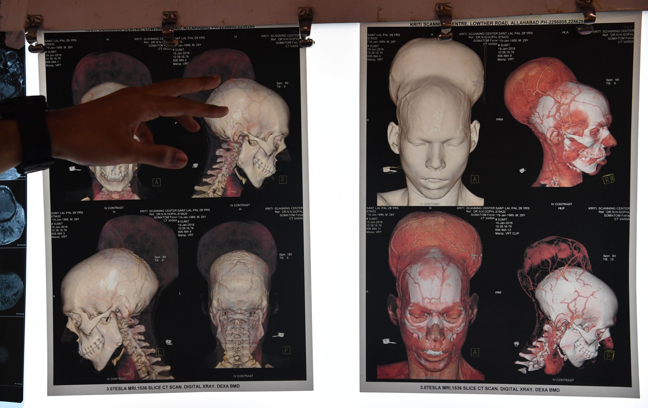 Massive, Four-Pound Brain Tumor May Be Largest Ever Removed