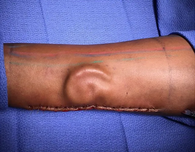 New Ear Grown on Soldier’s Forearm in First-of-Its-Kind Army Surgery ...