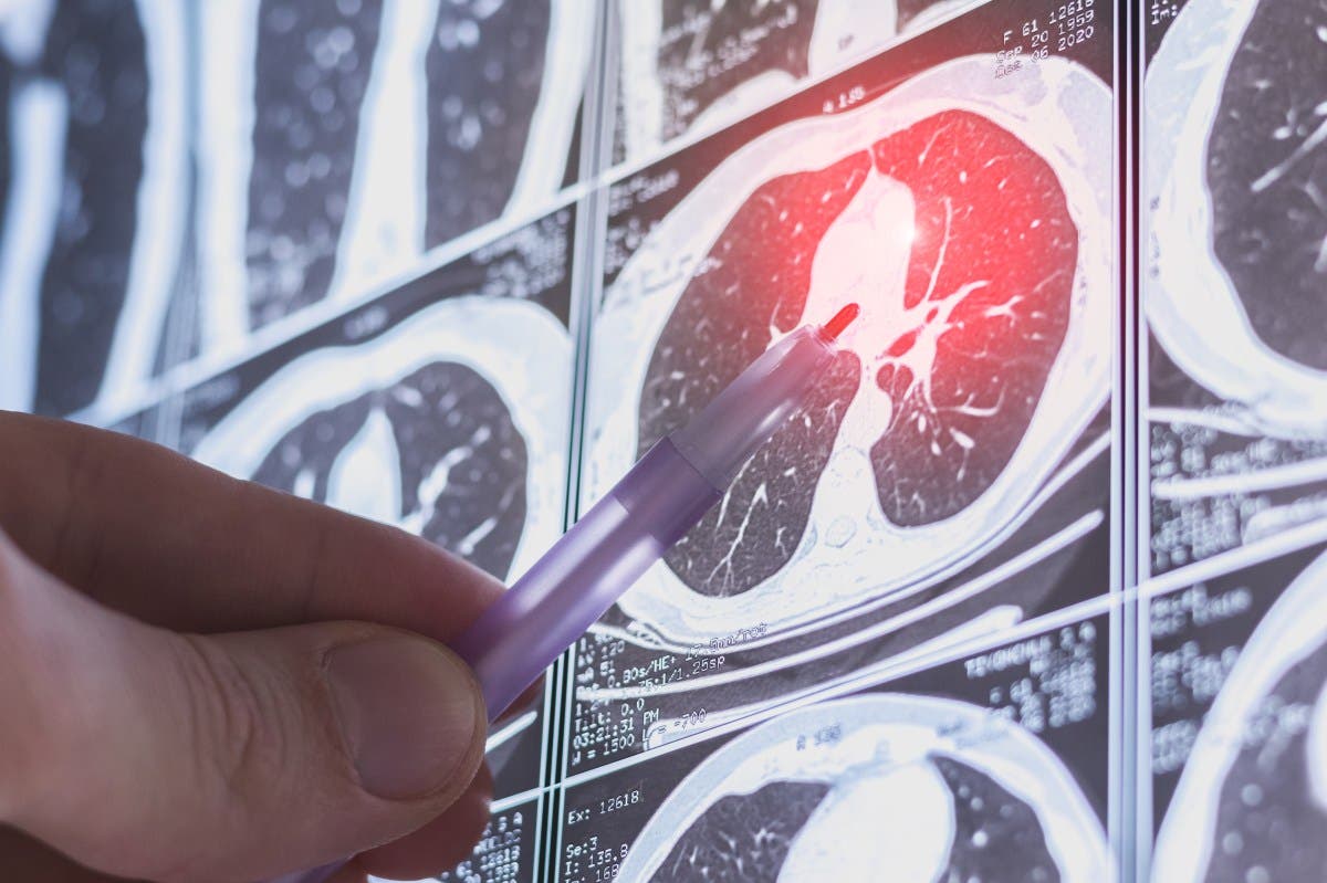 3D Printed Lungs Made With Living Cells May Be Treatment ‘Game Changer’