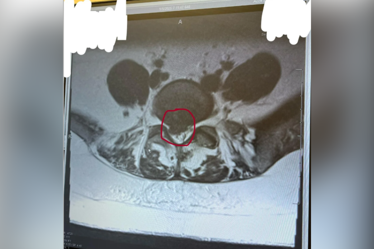 Woman Has Back Pain for 5 Years With No Answers—Then Hears Horrifying ‘Pop’