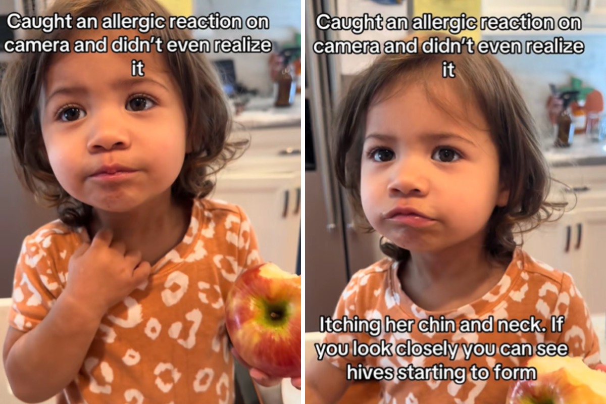 A Mother's Alarming Discovery: Toddler's Allergic Reaction Captured on Video