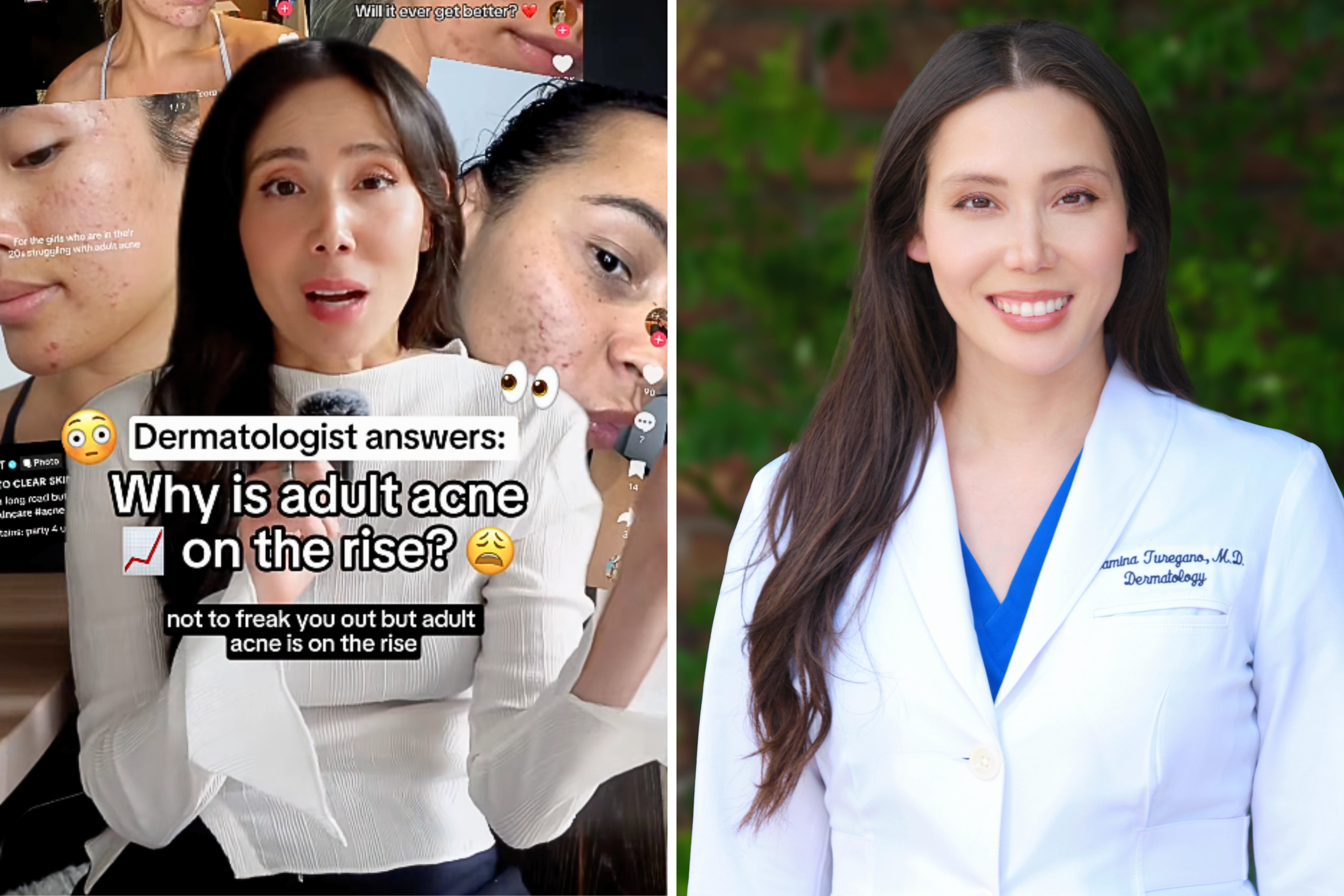 Dermatologist Reveals Why Adult Acne Is Surging Among Millennials and Gen Z