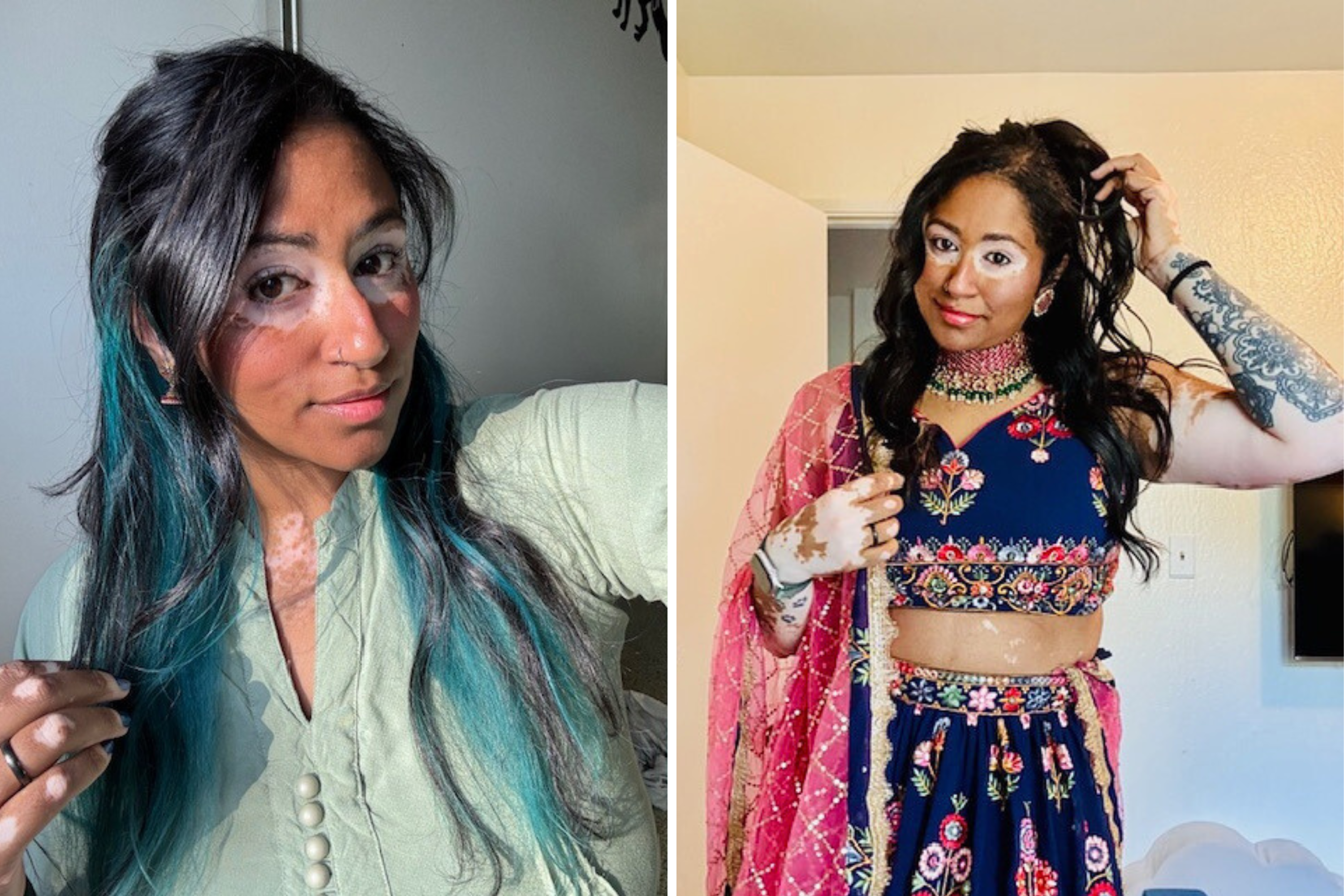 Woman With Vitiligo Since Childhood Starts Clinical Trial—Result Goes Viral