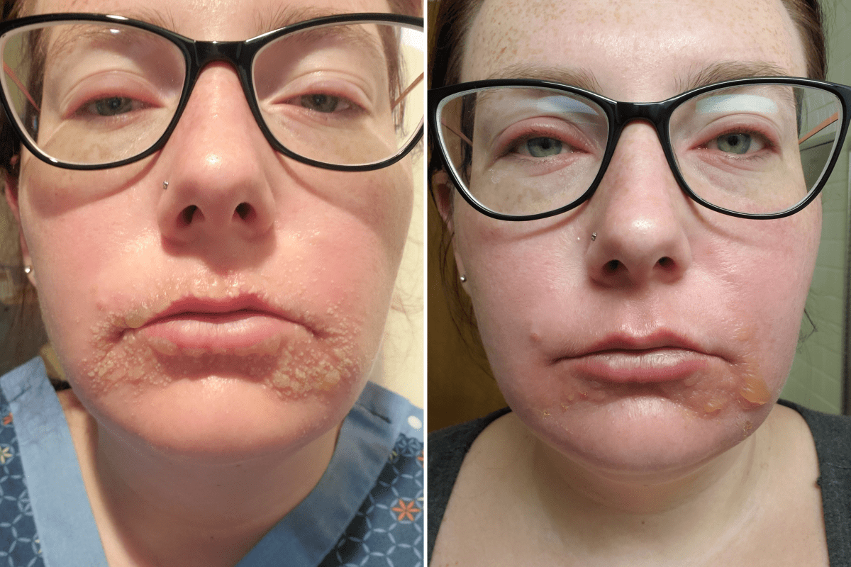Living with a Vampire's Suffering: Emily Richardson's Struggle with Stevens-Johnson Syndrome