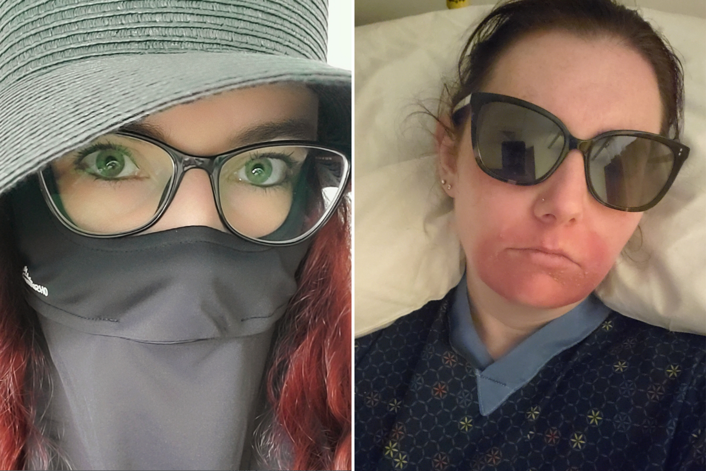 Woman Dubbed Real Life ‘Vampire’ After Being Diagnosed With Rare Condition