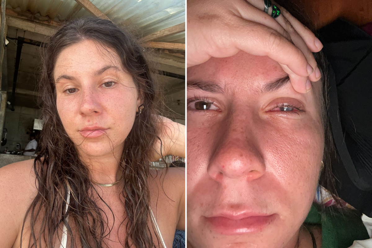 A Terrifying Encounter with a Rare Eye Parasite: Vivian's Journey