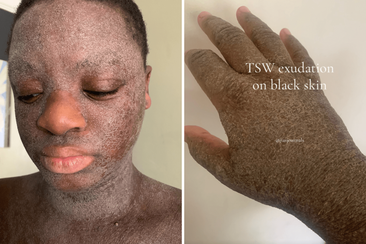 Woman Given Steroids as a Child&mdash;Now Faces Agonizing Condition