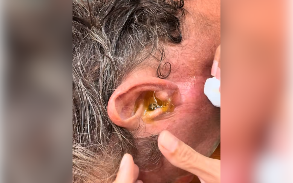 Man Can 'Hear Something in His Ear,' Wife Not Prepared for What Comes Out