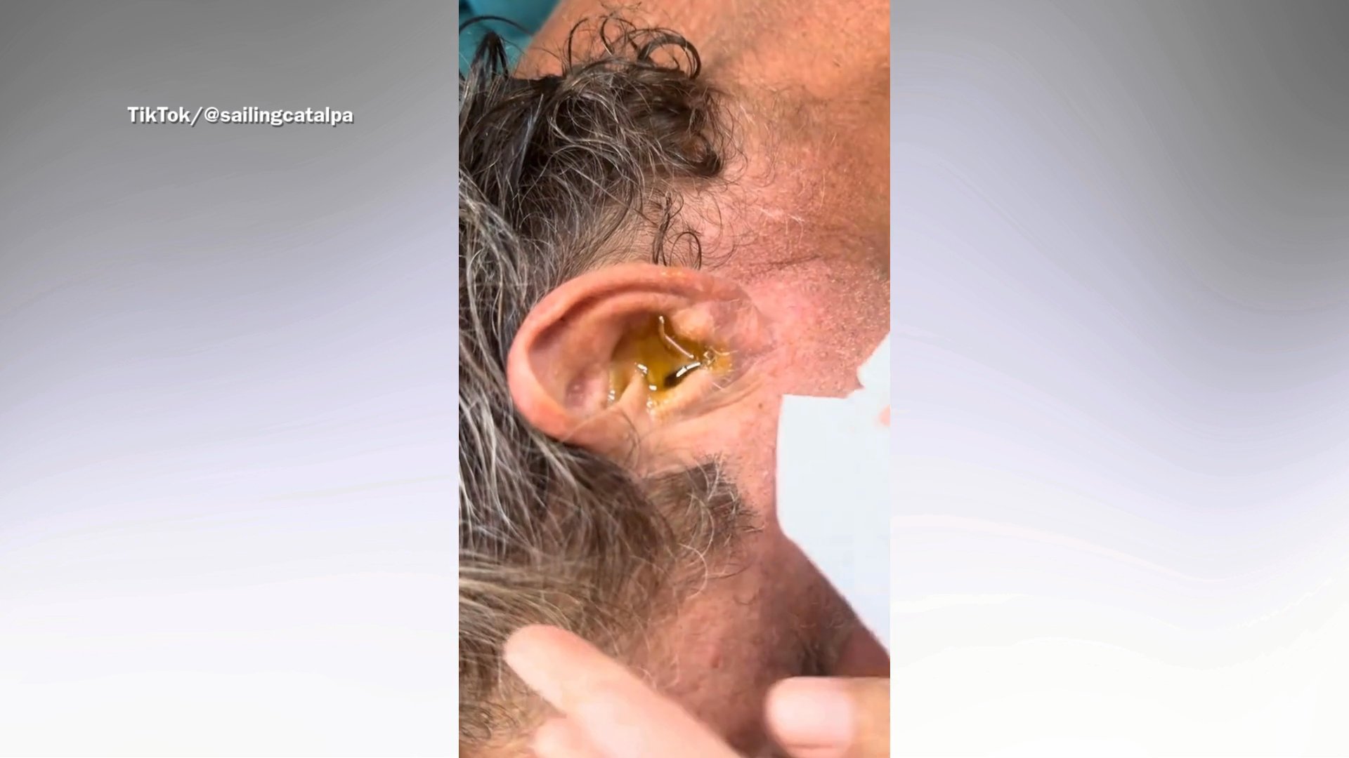 Man Can ‘Hear Something In His Ear’, Wife Not Prepared For What Comes ...