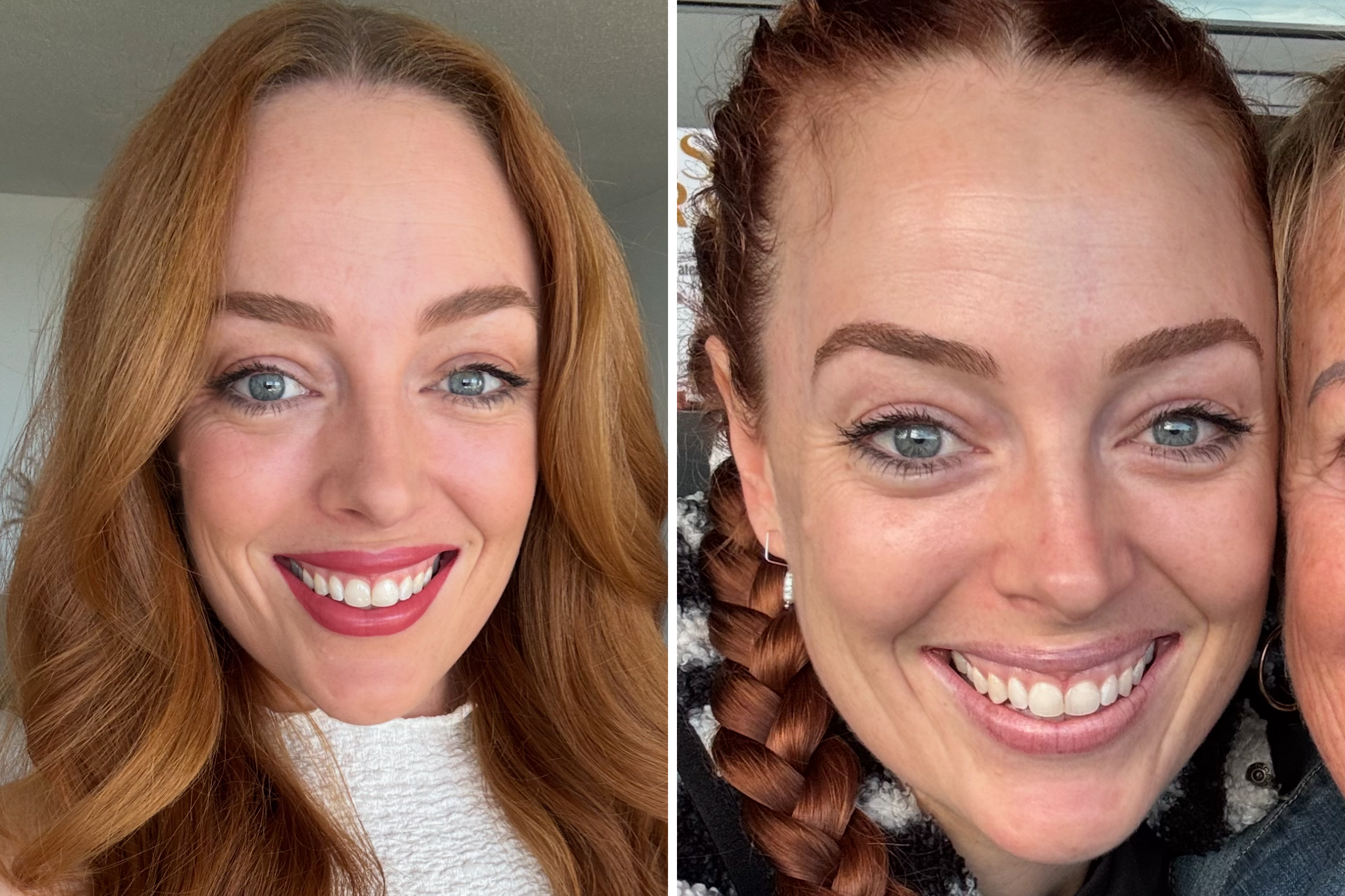 I Thought I Had a Pimple on My Nose, but It Changed My Life Forever