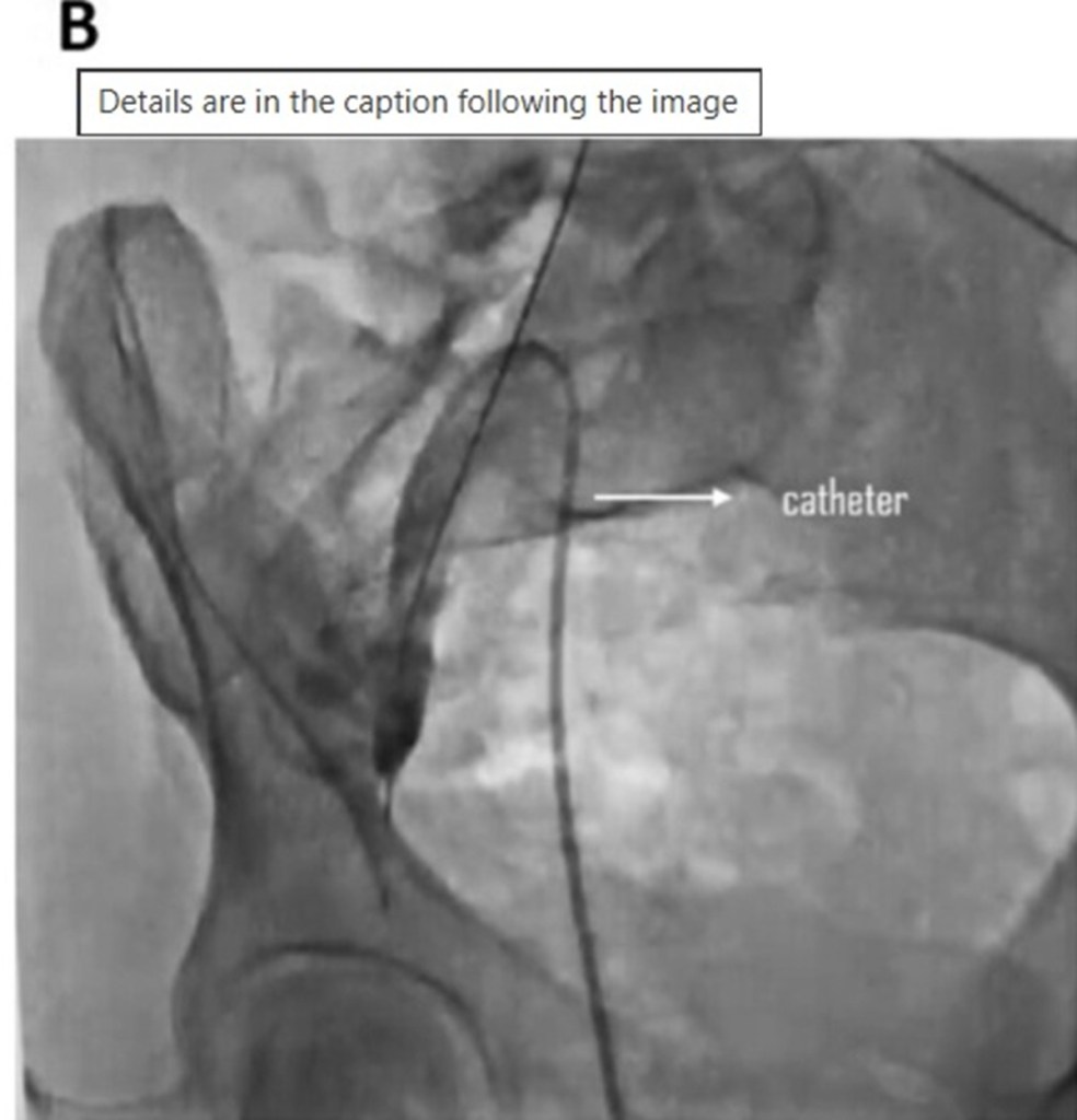 Woman Felt Fine Months After Procedure—X-Ray Reveals Object Left Inside ...