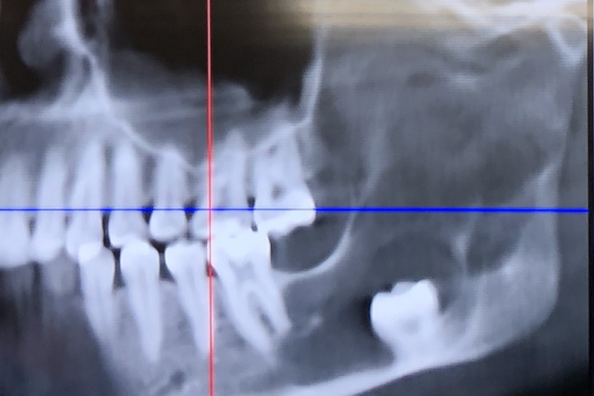Woman Thinks She Needs Wisdom Tooth Removed&mdash;Surgeons Find Something Else