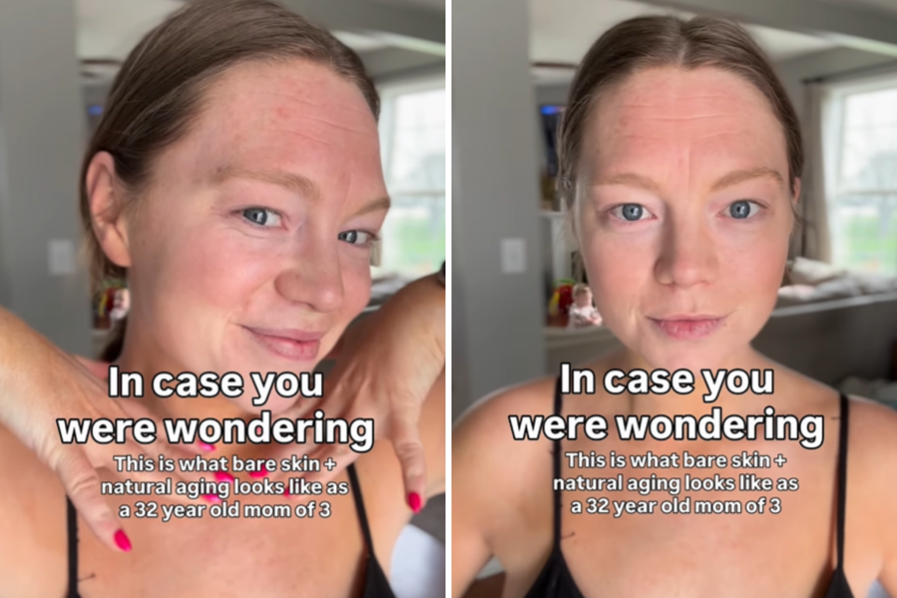 Mom of 3 Shares Her Natural Skin at 32, Not Prepared for Backlash