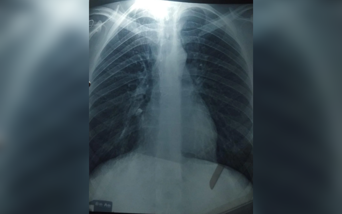 Man gets X-ray after "weird hiccups" begin—then doctors spot the problem