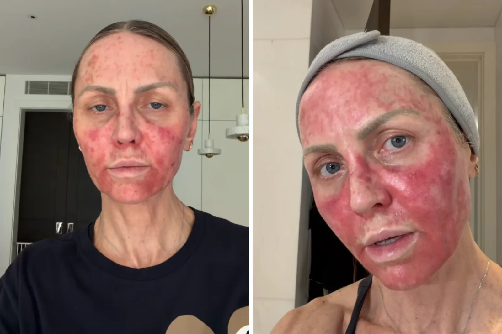 Woman issues urgent warning after skin treatment leaves her in agony