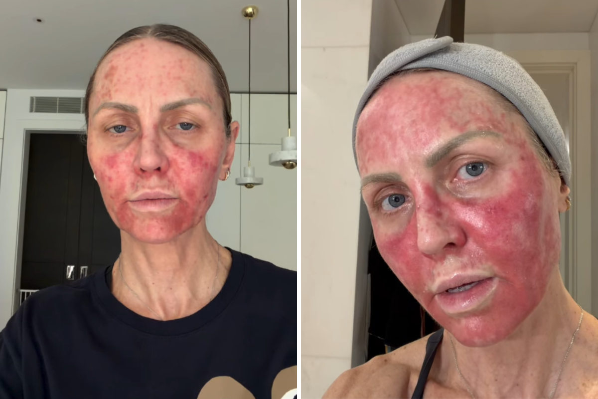 I Was Left in Agony After a Skin Treatment—Now I’m Warning Younger People