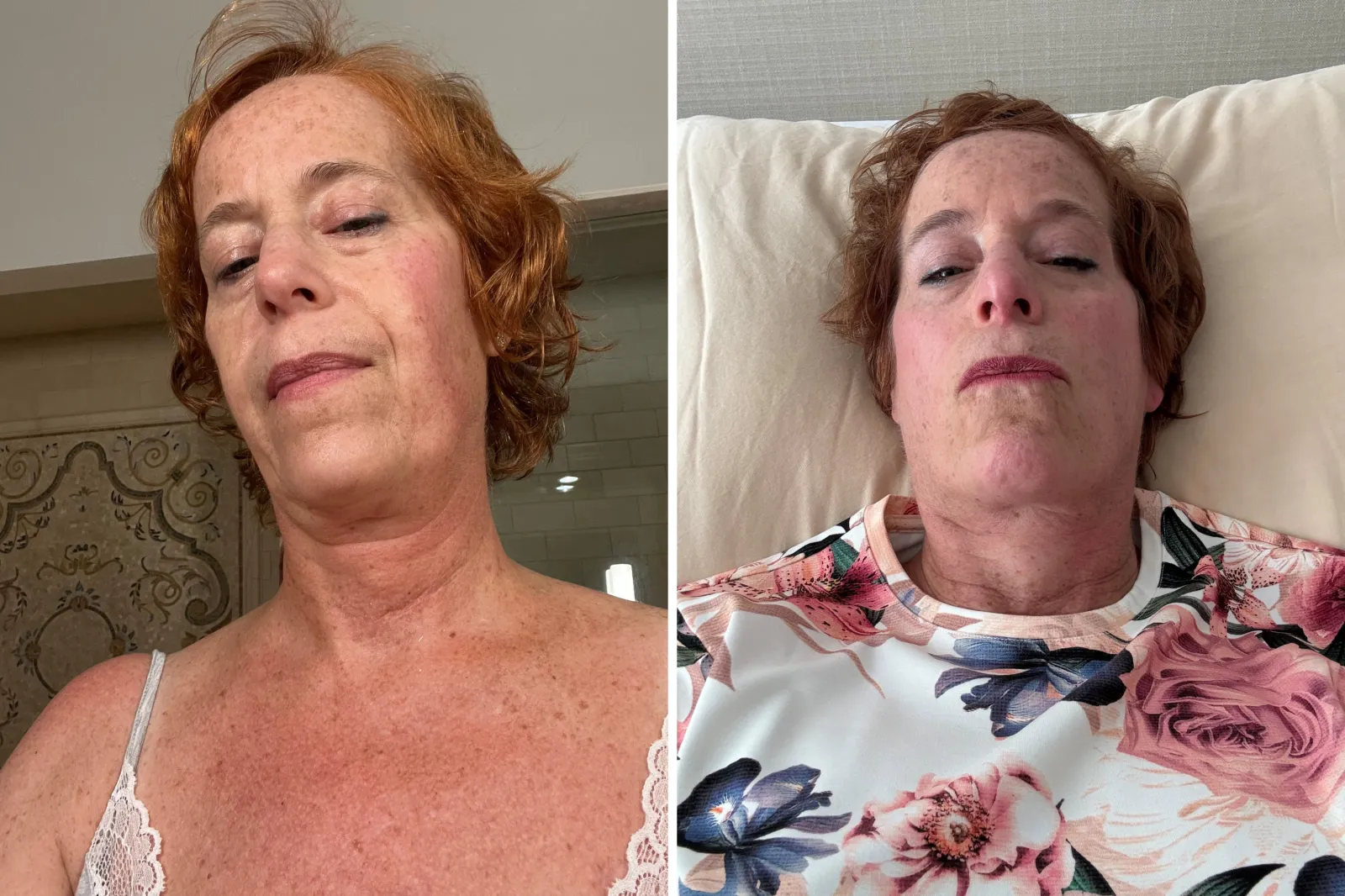 Dr. Obel during flares of a condition called mast cell activation syndrome (MCAS), which causes her to experience sudden flushing and an intense burning sensation.