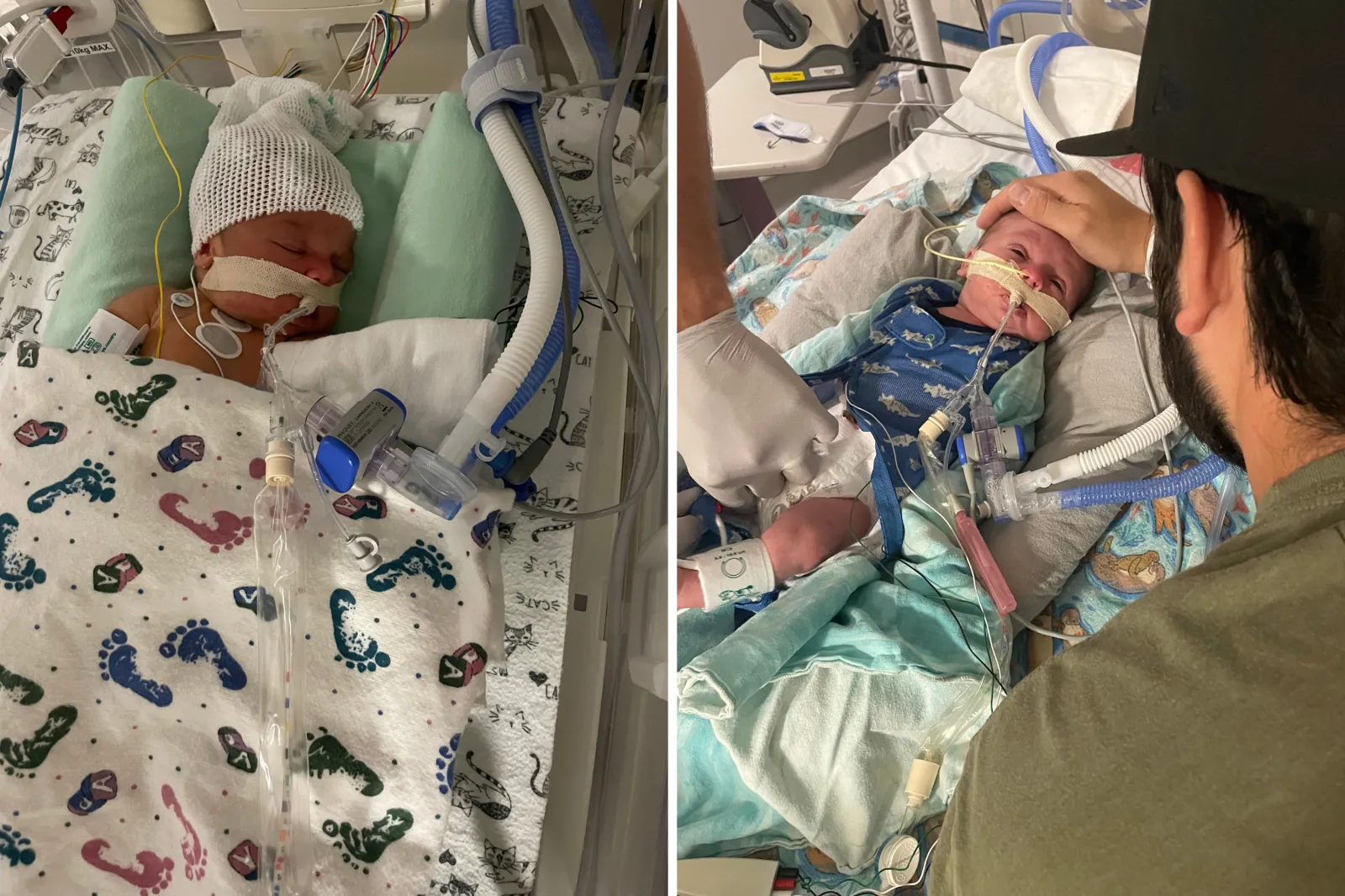 From left: Nolan lies as a newborn, hooked up to machines with a feeding tube connected to his nose; and his dad touches his head.