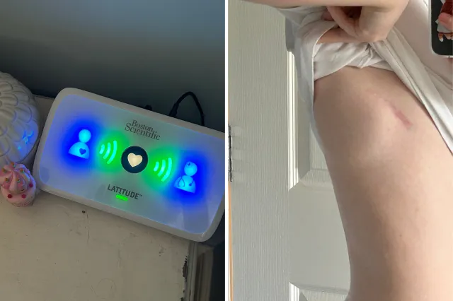 From left: a device to monitor Becca Travis's cardiac activity is seen; and one she had implanted in her body.