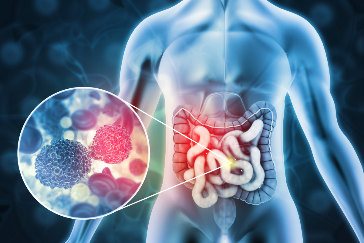 Colon Cancer Cells May 'Switch Identity' To Spread