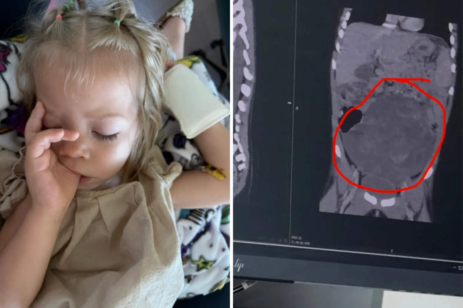 Adalae sleeping in hospital. A photo of her abdomen scan with a red circle highlighting the mass.
