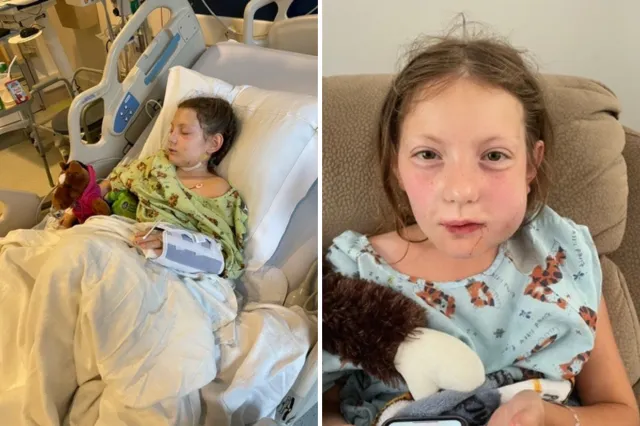 Emmy lying in a hospital bed after surgery to reconstruct her jaw.