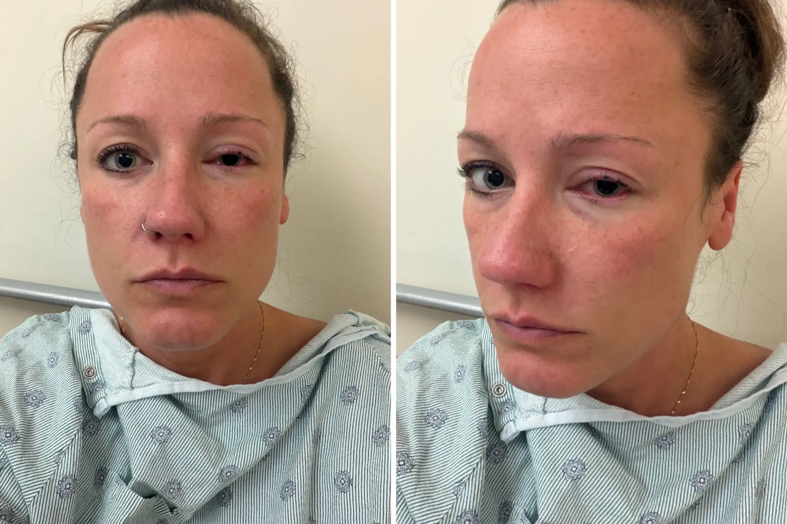 Leigh Stanger, 43, opening her eye in hospital.