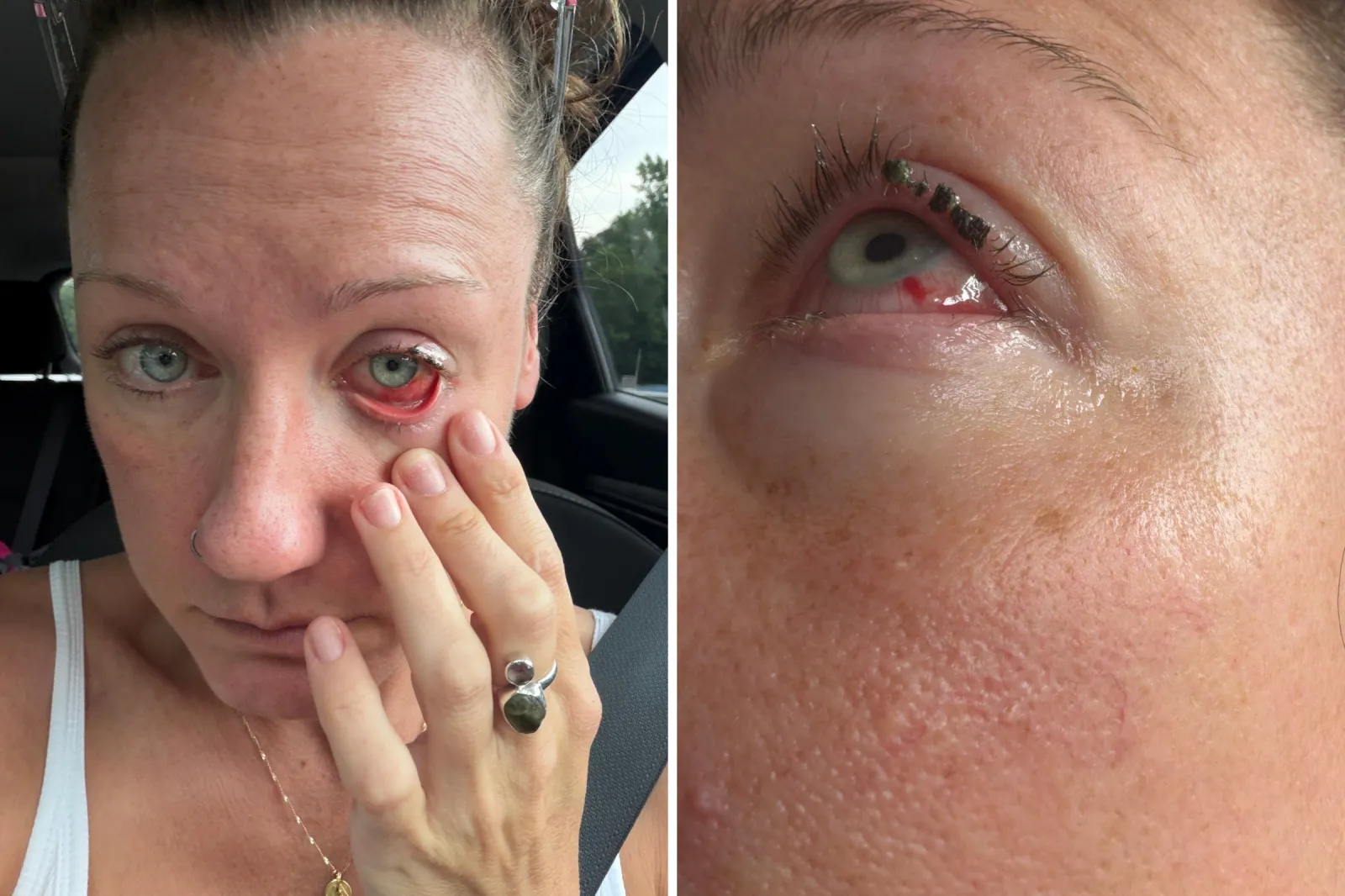 Leigh Stanger leaving the hospital after getting the glue removed.