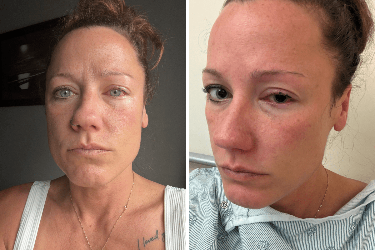 Woman Suffers Chemical Burns in Eye After Making O
