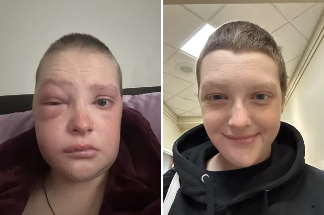 Brittany Christianson during chemotherapy and radiation.