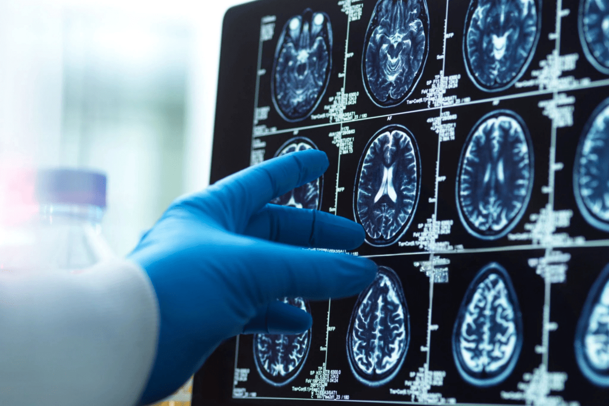 One Protein May Prevent Brain Process Linked to Alzheimer's and Parkinson's