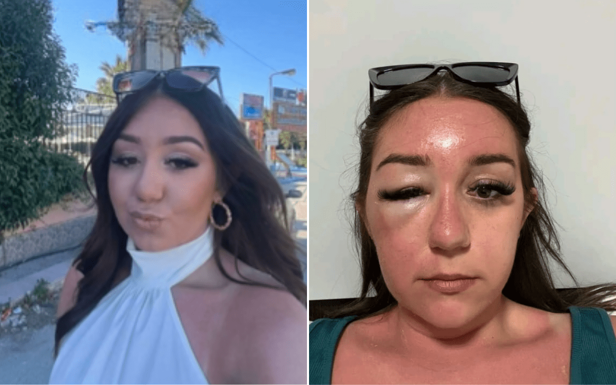 Woman on Vacation Notices ‘Bag’ Under Eye, Then Comes Terrifying Reality