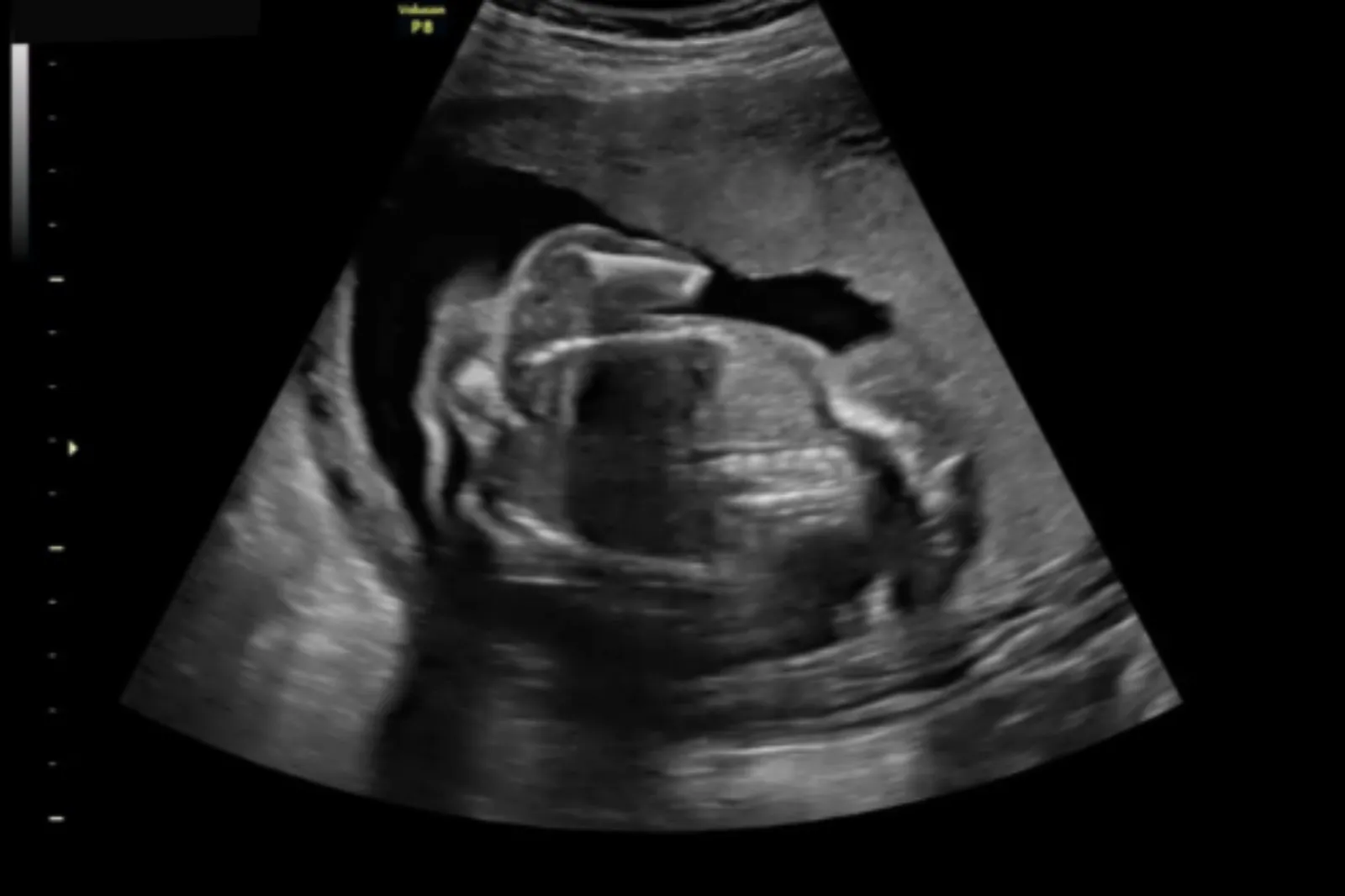 A still image of the 21-week anatomy scan is seen.