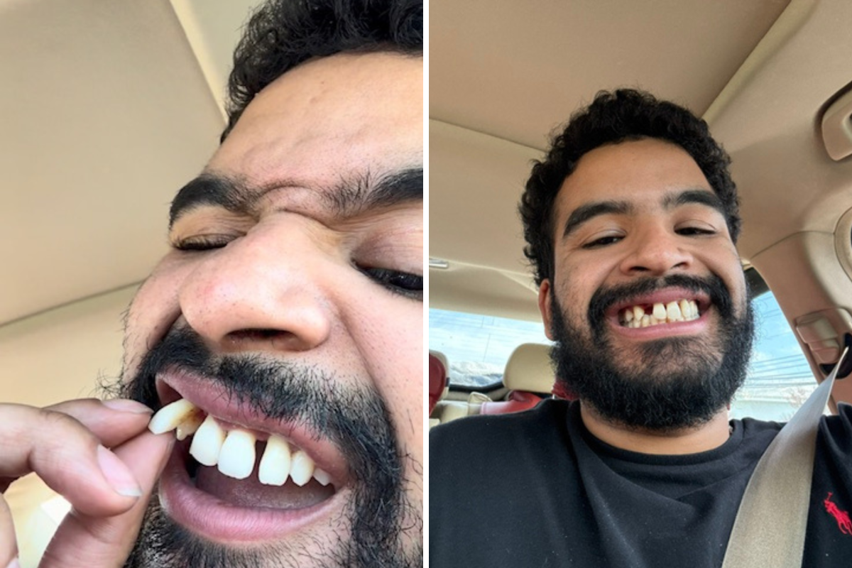 I Thought I Needed To Wear My Retainer More, Then All My Teeth Fell Out